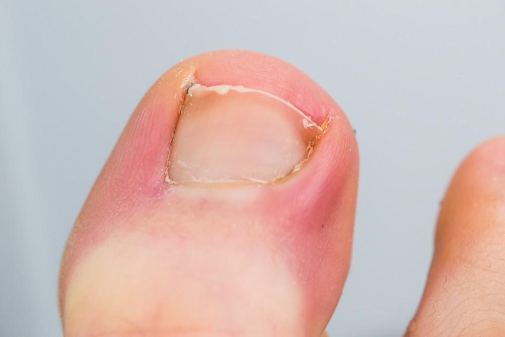 Why Is My Toenail Sore